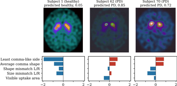 Three DaT-SPECT scans with outlined striatal regions and bar charts of each feature's contribution
